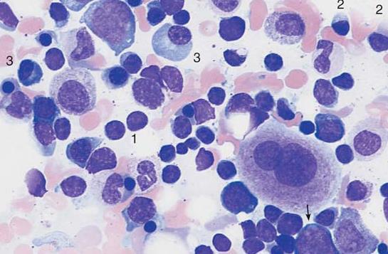 Waldenstrőmova makroglobulinemie (WM) / Lymfoplazmocytární lymfom (LPL) - lymfoproliferativní onemocnění jako následek nádorové transformace lymfocytů, plazmocytů - Medián při diagnóze 60 let -