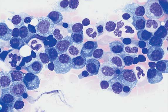 Myelom plasmatické buňky - 3 stádia dle Durie a