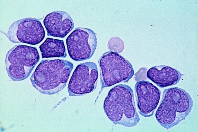 Lymfom plášťové zóny / Mantle cell lymphoma (MCL; lymfom z plášťových buněk) -5-8% NHL,