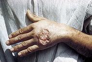 Kala Azar / Leishmaniasa Leishmania