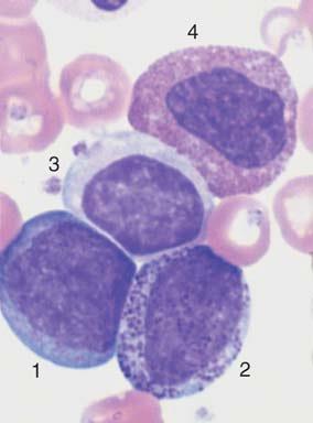 Chronická myeloidní leukemie (CML), BCR-ABL + - Cytogenetický nález (~95%) -
