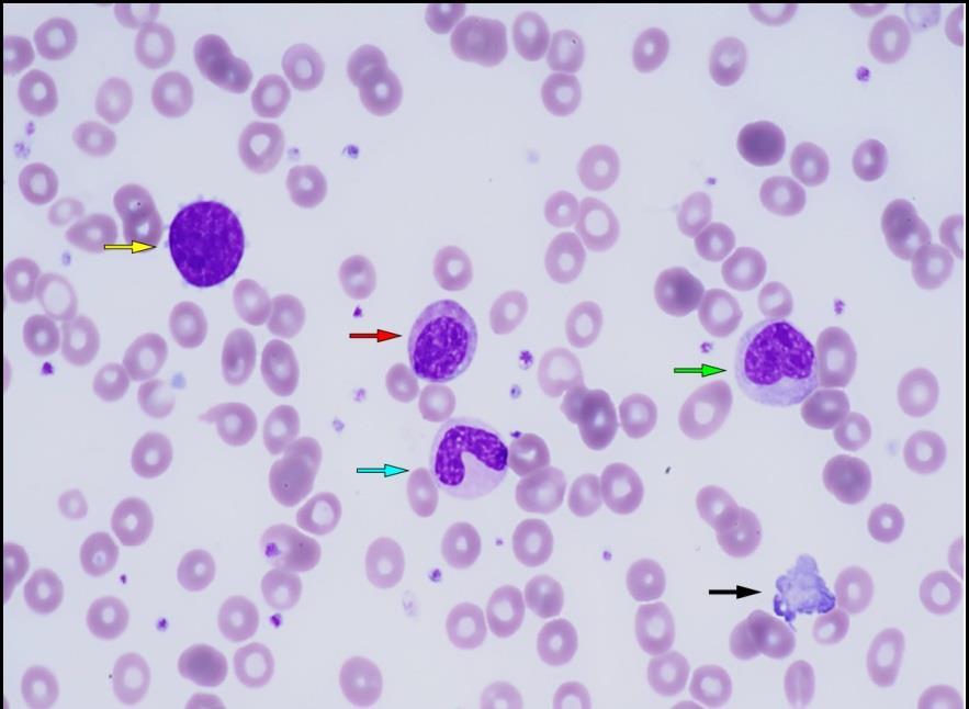 Primární myelofibróza (PMF) - Onemocnění krvetvorné buňky vedoucí ke zvýšené megakaryopoéze a myelopoéze