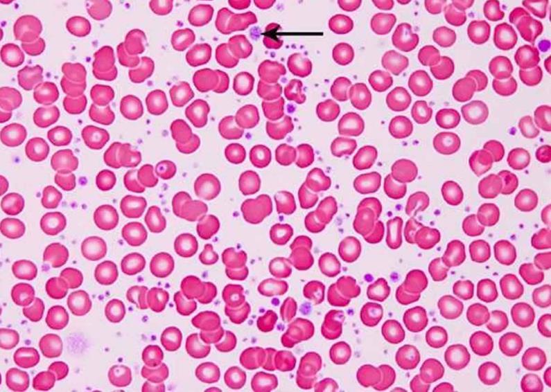 Esenciální trombocytemie (ET) - Klonální proliferace megakaryocytů - Incidence 15-25/milion obyvatel doba