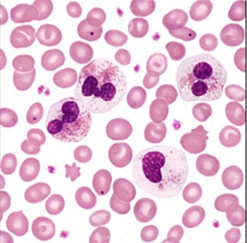 Chronická eozinofilní leukemie - + krevní malignity s eozinofilií spojené s geny PDGFRA,
