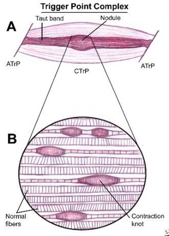 Spoušťové body jsou citlivé oblasti napjatých svalových vláken, na Obr. 2 Spoušťový bod nichž se nachází kontrakční uzlíky (viz obrázek 2). Mohou ve svalu způsobit únavu a bolest (Mayoclinic.