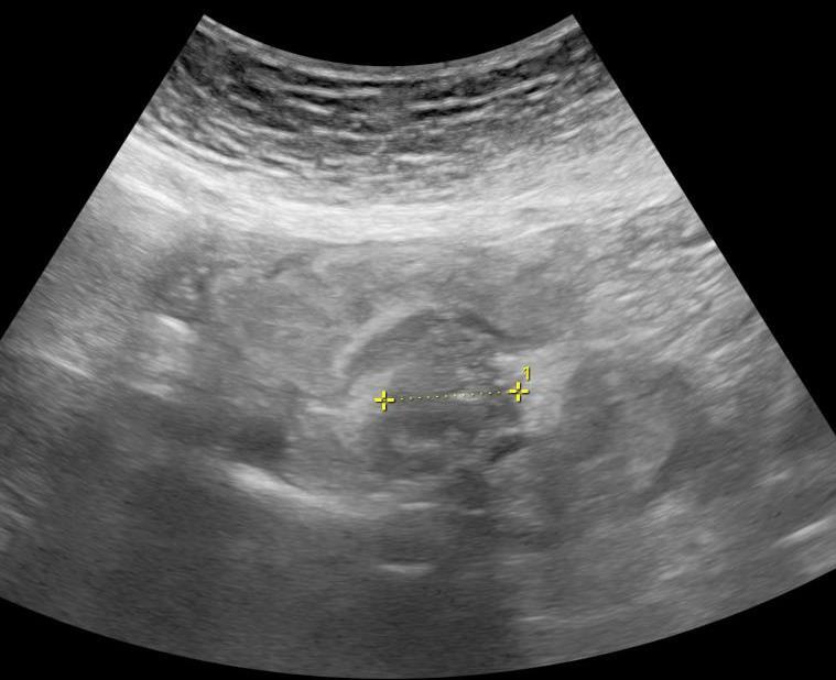 KARCINOID Neuroendokrinní tumor Tenké střevo -plaka na střevě, polyp; měkkotkáńová masa v mesenteriu