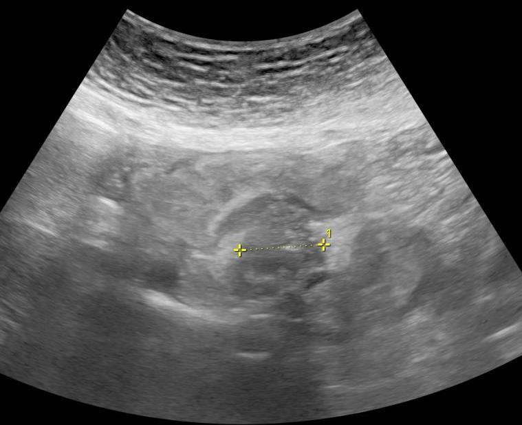 KARCINOID Neuroendokrinní tumor Tenké střevo -plaka na střevě, polyp; měkkotkáńová masa v mesenteriu