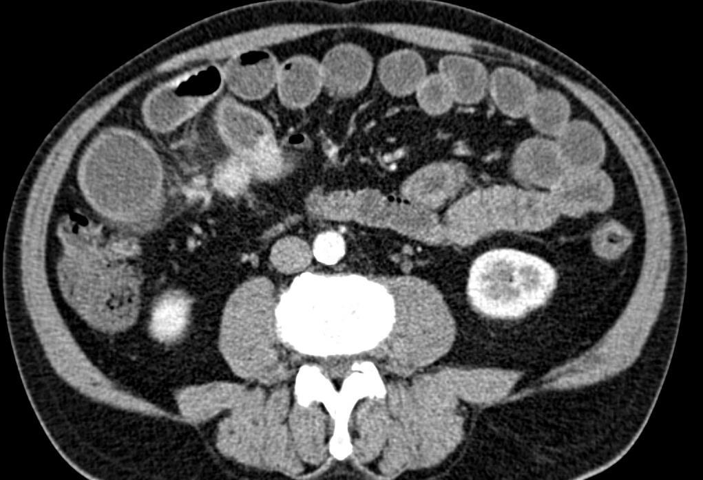 arteriální fázi Metastázy játra, mesenterium DD: retraktivní mezenteritida, desmoid, lymfom Symptomy jsou