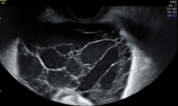 intraabdominální CT: uni/častěji multilokulární cystický útvar