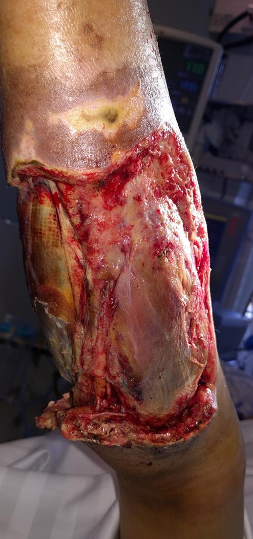 zlepšení oxygenace vysazení vazopresorů