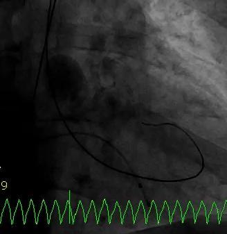 Kazuistika 1M FU po PCI: nedošlo ke zlepšení dušnosti BAV: 3x dilatace balonkem 23mm/ 5 sec PG 27mmHg.