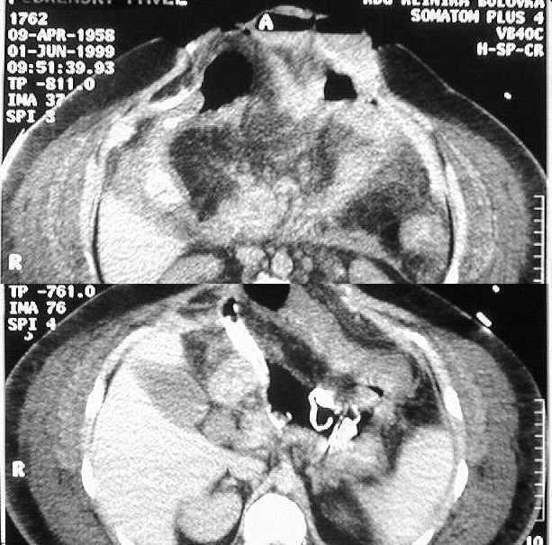 Perkutánn nní CT cílenc lená drenáž akutní nekrotizující pankreatitidy Příčiny pankreatitidy: alkoholismus - 27 nemocných onemocnění žlučových cest - 40 ERCP - 7 (ERCP-4,ERCP+papilo 4,ERCP+papilo-