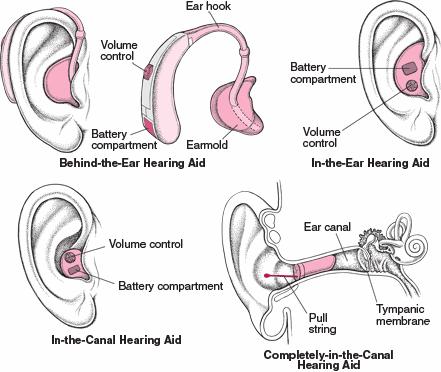 Příloha 2 Typy sluchadel Zdroj: (38) Vysvětlivky: Behind the Ear Hearing Aid závěsné sluchadlo; In the Ear