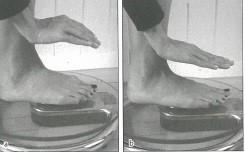 Když pacient udělá kulovitou ruku, tak noha vytvoří píďalku, u talířovité ruky příčnou klenbu uvolní. Cvik by se měl provádět na každé noze 30 vteřin 3-5 krát.