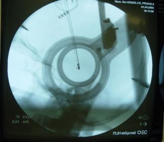 implantace kabelu implantace