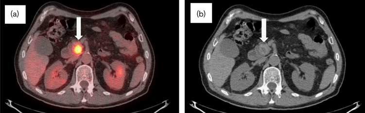 BI THERAPEUTICS kazuistika CT/PET vyšetření z listopadu 2008, 18 měsíců po diagnostikování choroby.