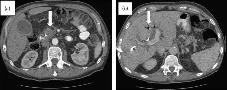 Tyto snímky byly pořízeny v lednu 2011 na pohotovosti, kde byl pacientovi diagnostikován septický šok 2 týdny po zavedení biliárního stentu.
