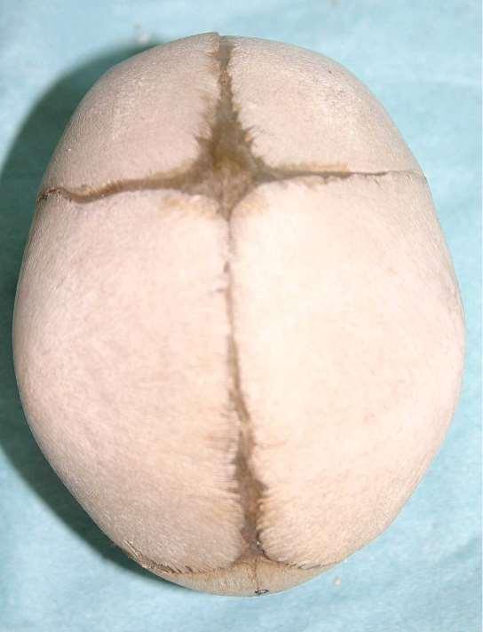 Fetální lebka Calva Tuber frontale