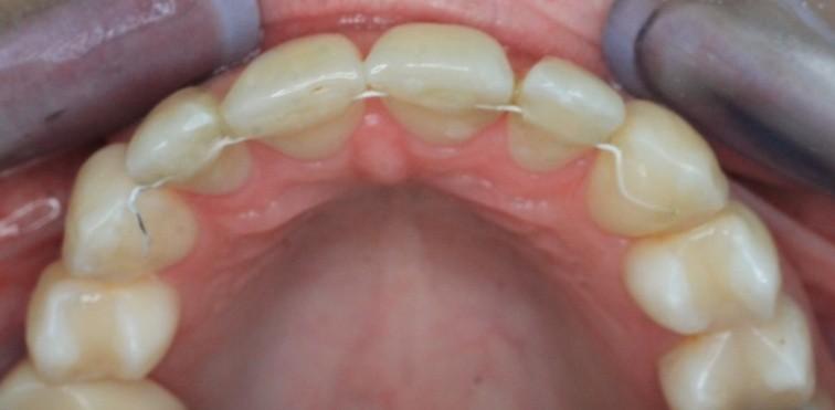 V případech, kdy je potřeba nahradit větší počet zubů, lze použít pro retenci i