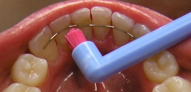 3.6 Péče o chrup s fixním retainerem Po nasazení fixního retaineru by měl být pacient vždy poučen o provádění správné ústní hygieny.