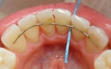 zubu, po které se stáhne do gingiválního sulku a poté vytáhne zpět k bodu kontaktu. Pohyb je nutné provést vícekrát.