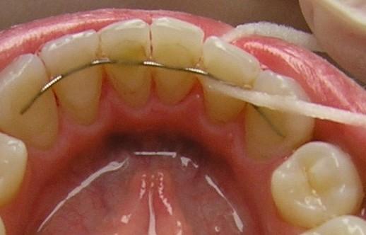 Superfloss je speciální zubní nit, kterou lze zavést přímo do mezizubního prostoru, bez nutnosti projít přes bod kontaktu. Skládá se ze tří částí.