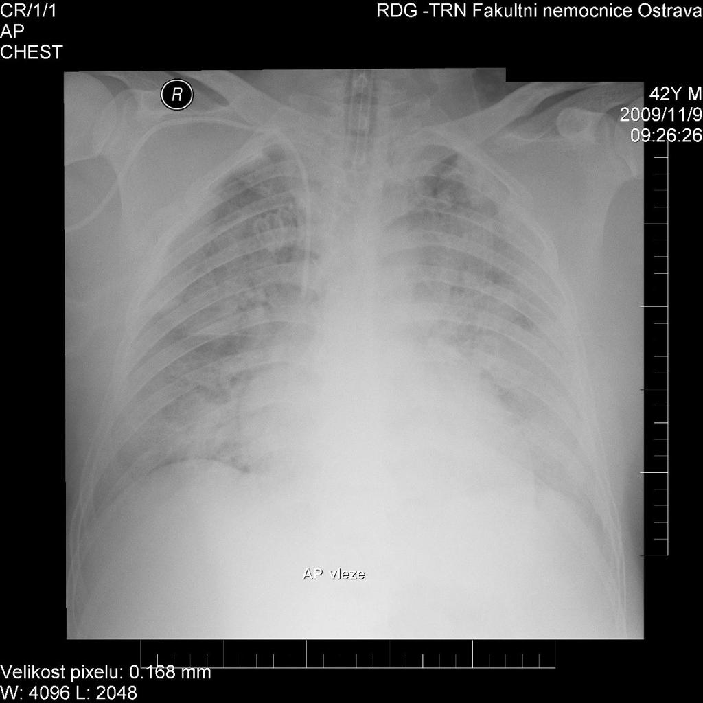 2. kazuistika: Pneumonie chřipka A