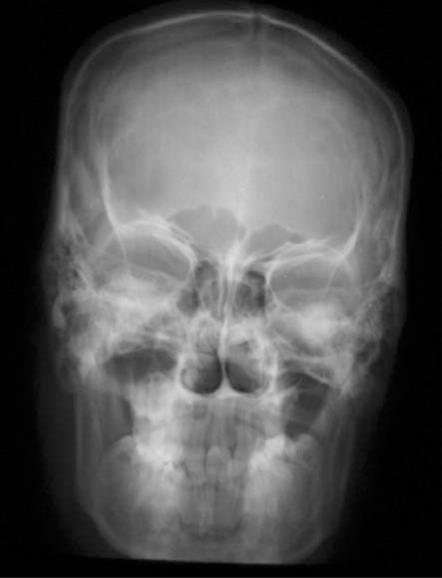 Obr. 3: Posteroanteriorní projekce. Zdroj: http://openi.nlm.nih.gov (21.