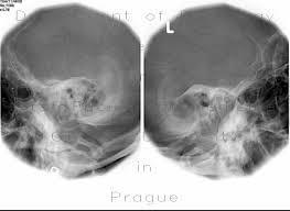 24/30 cm. Využití v traumatologii, diagnostice lebečních asymetrií, asymetrii kondylů, v zubním lékařství je vhodná pro diagnostiku extrémně uložených horních třetích molárů.