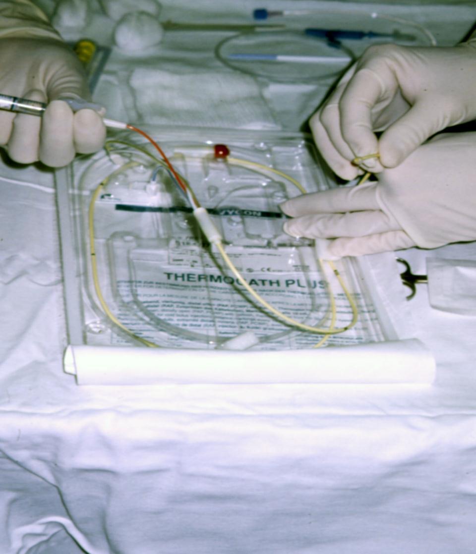 Neurochirurgická intervence Perioperativní léčba vzduchové žilní embolie 1. Identifikováno místo nasávání - úkol neurochirurga. 2. Zastaven přívod oxidu dusného, zvýšen průtok O 2. 3.