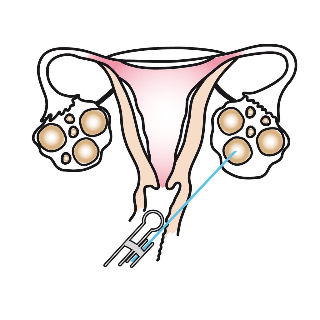 Aspirace