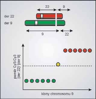 Genetické zmûny spojené s progresí nádorû PouÏití array CGH technologií pfiispûlo také k porozumûní nûkter m zmûnám, které pozorujeme v dobû progrese onemocnûní. Martinez-Climent a spol.