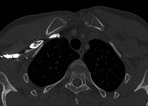 A you can see the enlarged medial end of the first rib with an irregular edge, osteolysis prevails.