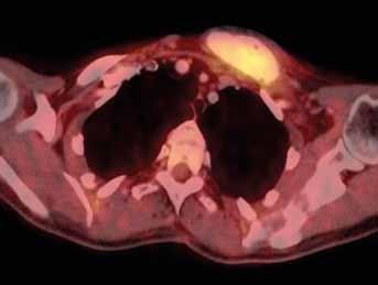Obr. 3 Obr. 4 Obr. 3. PET/CT z roku 2013. Patrná akumulace FDG v oblasti sternokostálního skloubení 1. žebra vlevo Fig. 3. PET/CT from 2013.