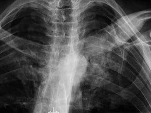 Hyperostóza klíčku, rozšíření periostálně i endostálně; osteoproduktivní změny na sternokostálním skloubení 1. žebra vlevo; méně vyjádřené změny i vpravo Fig. 4.