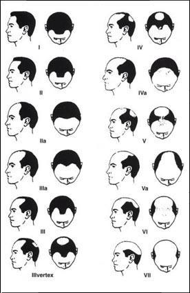 Alopecia androgenetica byla popsána Aristotelem Muži: charakteristické zkrácení