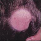 Alopecie po ozáření Po jednorázovém ozáření části kapilicia ionizujícími paprsky ve vyšší dávce (např.