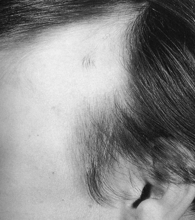 Alopecia triangularis idiopatická porucha Alopecia triangularis (kongenitální trojúhelníkovitá alopecie) - idiopatická vrozená porucha zahrnující temporální oblasti; folikuly chybí; alopecie má