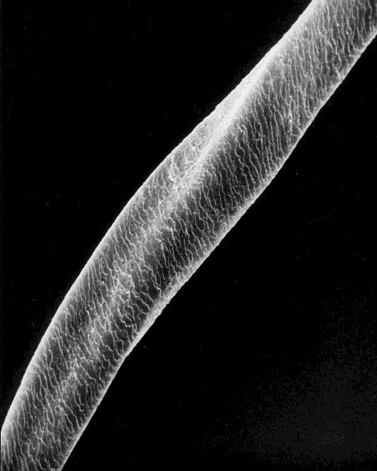Alopecia suturalis Hallermann/Streiff sy vlasy jsou jemné místy ztráta kutikuly žlábkované vlasy