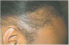 Trichotillomania z řeč.