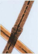 Trichorrhexis invaginata syn.
