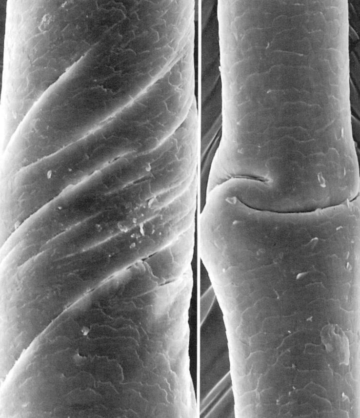 PSS peeling skin syndrom vlasová torze Trichorrhexis invaginata autosomálně recesivní sy; dermatóza odlupování stratum