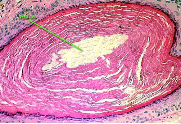 Trichostasis spinulosa Trichostasis spinulosa je charakteristická mnohočetnou matrix se společným folikulárním ústím; porucha vzniklá v důsledku retence vellusových vlasů uvnitř folikulu, nebo se