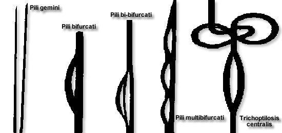 Pili bifurcati pili bifurcati (podle Comacho, 1998) můžeme klasifikovat na: pili gemini: po rozdvojení stvolu nedochází k opětovné fúzi, papila a matrix jsou rozdvojené pili multigemini: po