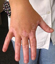 Vitiligo (vit-ill-eye-go) faktory