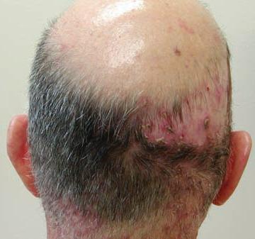 Folliculitis