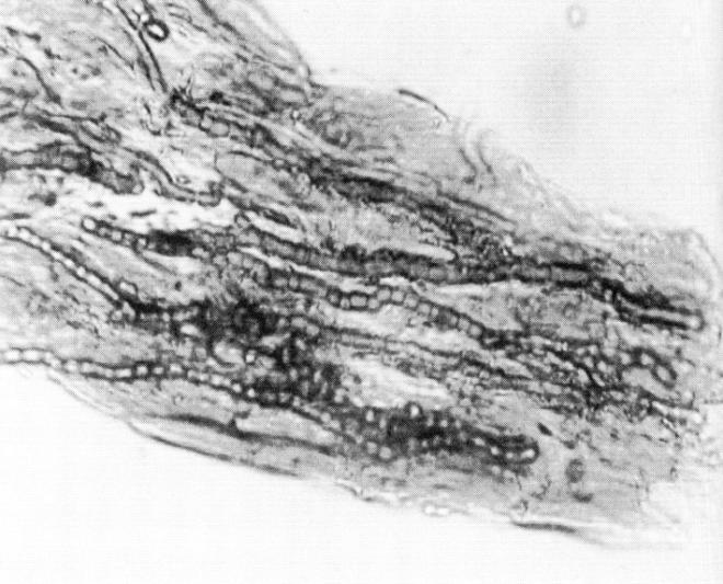 kulovitá arthroconidia uvnitř vlasu Endothrix Endothrix kulovitá arthroconidia (5-8 µm) se hromadí uvnitř vlasu, kutikula není poškozená.