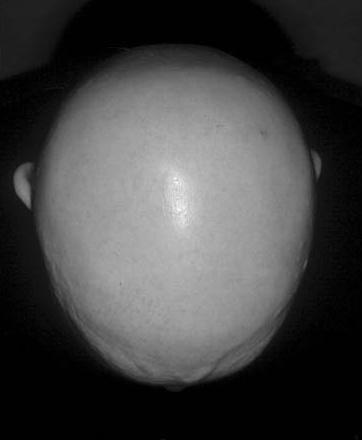 alopecie
