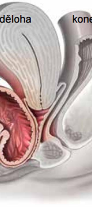 pelvic organ prolapse POP) je vyboulení či vysunutí