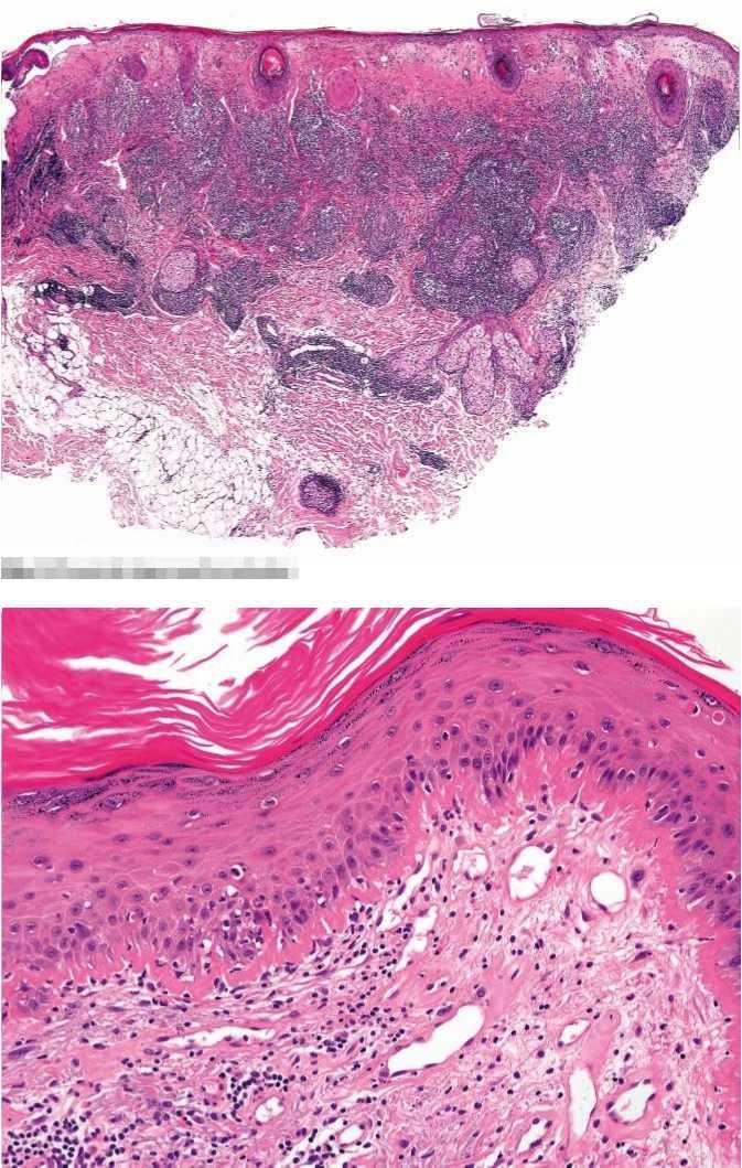 CELOŽIVOTNÍ VZDĚLÁVÁNÍ Hypertrofický (verukózní) lupus erythematodes Jedná se o vzácnější variantu chronického LE charakterizovanou výraznou hyperkeratózou.